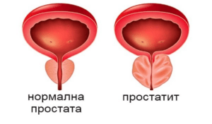 Бактериален простатит: симптоми, причини и лечение